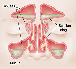 Front view of sinuses showing red, swollen lining and mucus.