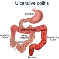 UlcerativeColitis_Fig_1