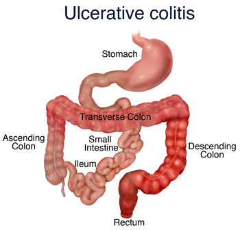 UlcerativeColitis_Fig_1